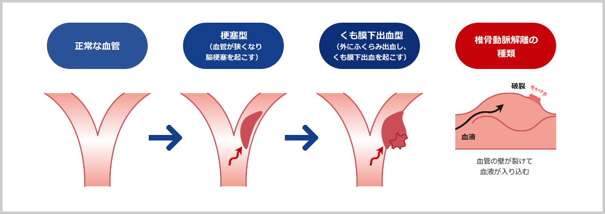 未破裂脳動脈瘤について 未破裂脳動脈瘤 医療法人 青心会 郡山青藍病院