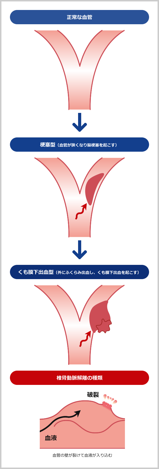 未破裂脳動脈瘤について 未破裂脳動脈瘤 医療法人 青心会 郡山青藍病院